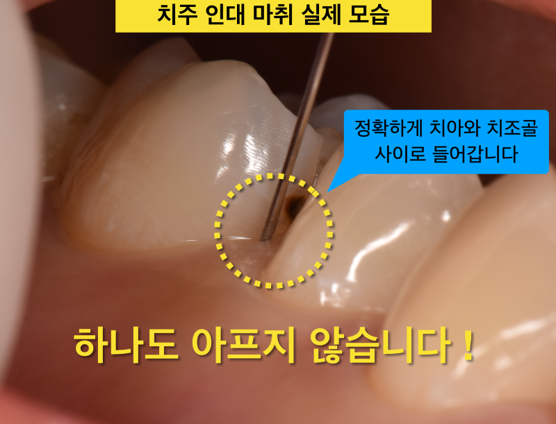 치과마취 안아프게 치료받는 꿀팁! 치과마취통증 없이~ 치주인대마취 알고가기 사진 3