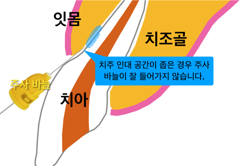 [안아프게마취/치과치료안아프게] 치주인대마취 장비와 방법