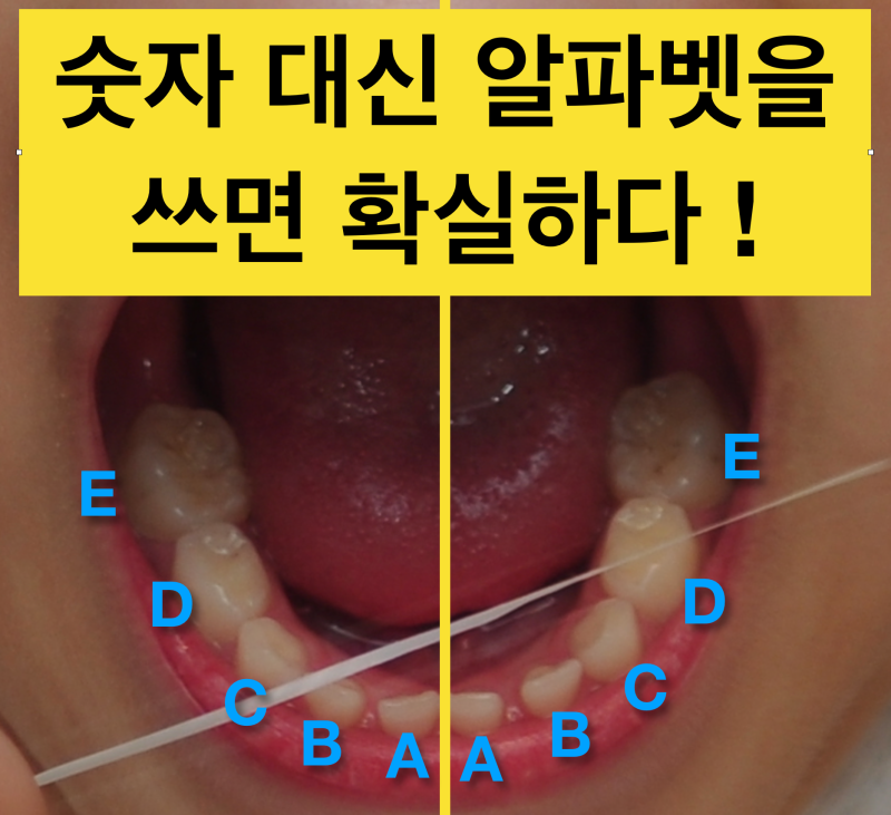 유치갯수, 유치 치아번호를 알아보자 (치과의료사고 예방, 영구치와 유치 혼동 주의 !) 사진 5