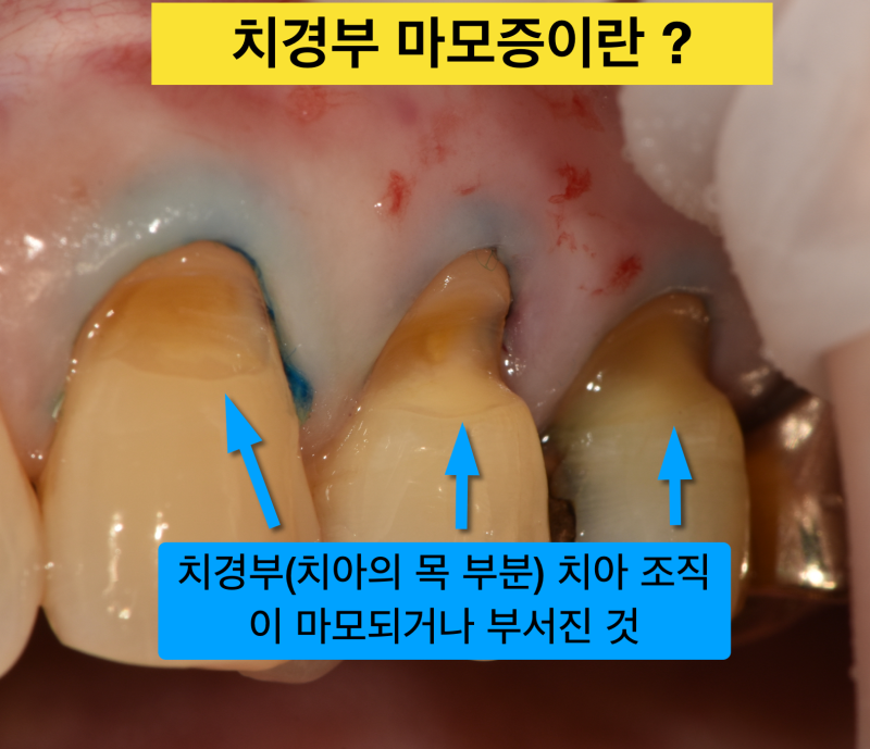 [극심한 치아통증]치경부레진 후 통증, 레진 치료 후 통증, 그 이유는?