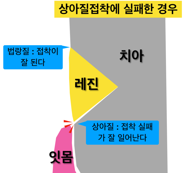 [극심한 치아통증]치경부레진 후 통증, 레진 치료 후 통증, 그 이유는? 사진 4