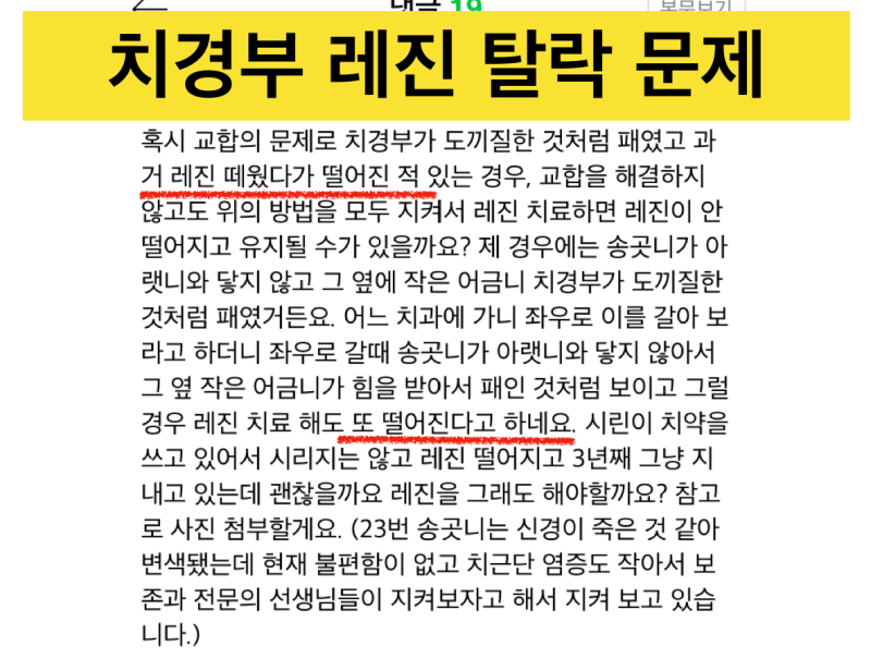 [극심한 치아통증]치경부레진 후 통증, 레진 치료 후 통증, 그 이유는?