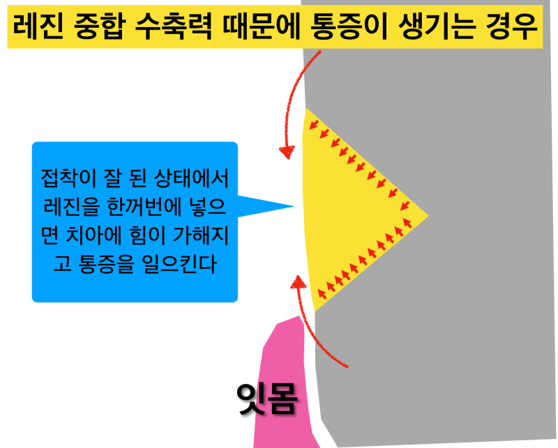 [극심한 치아통증]치경부레진 후 통증, 레진 치료 후 통증, 그 이유는? 사진 5