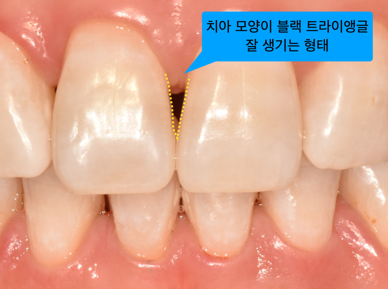 [치과치료부작용] 치아 교정 치료 후 잇몸 내려감, 치아벌어짐_블랙트라이앵글 해결 방법 사진 3