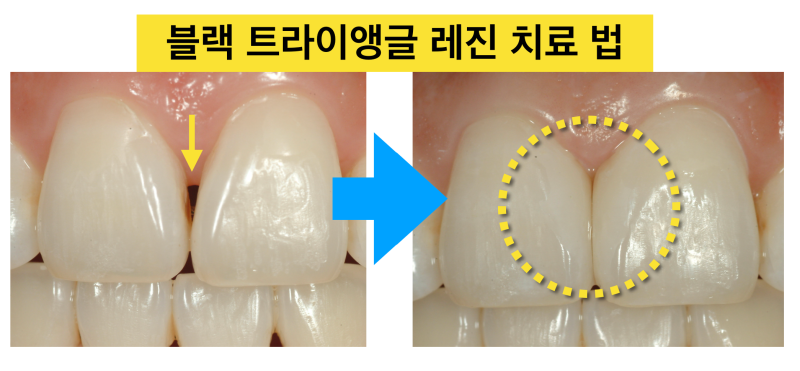 [치과치료부작용] 치아 교정 치료 후 잇몸 내려감, 치아벌어짐_블랙트라이앵글 해결 방법