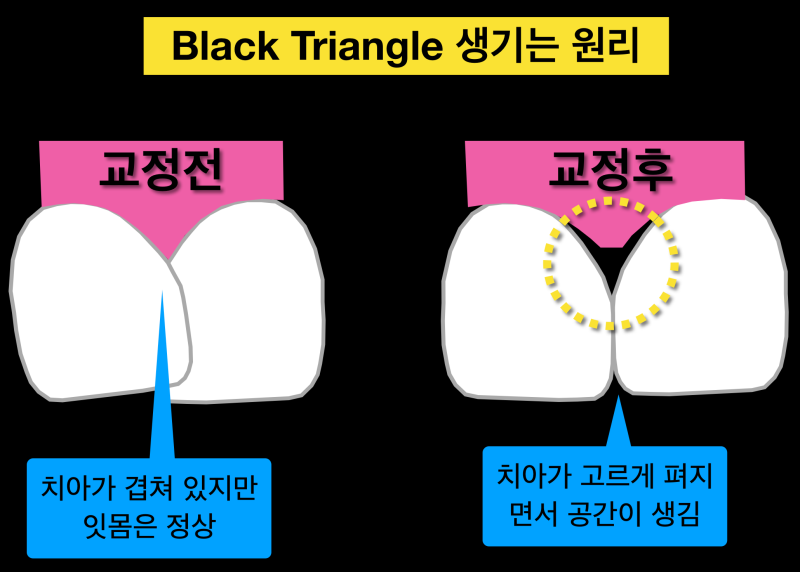 [치과치료부작용] 치아 교정 치료 후 잇몸 내려감, 치아벌어짐_블랙트라이앵글 해결 방법 사진 2