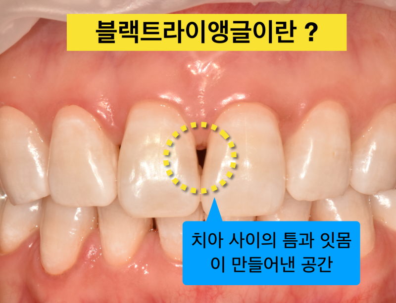 [치과치료부작용] 치아 교정 치료 후 잇몸 내려감, 치아벌어짐_블랙트라이앵글 해결 방법