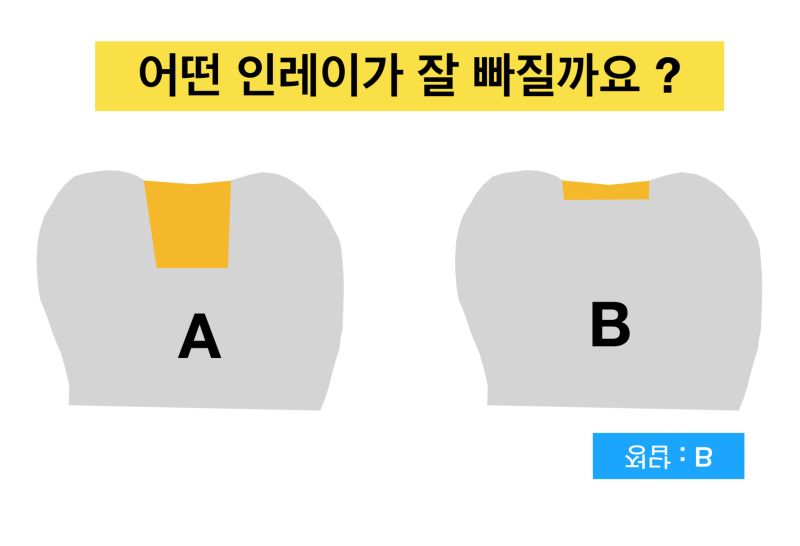 인레이 탈락, 금인레이 떨어지는 이유_캬라멜 먹다가 보철 빠지는경우_금니떨어짐 사진 5