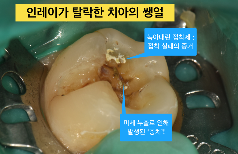 인레이 탈락, 금인레이 떨어지는 이유_캬라멜 먹다가 보철 빠지는경우_금니떨어짐 사진 4