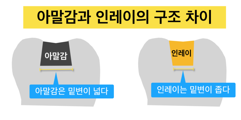 인레이 탈락, 금인레이 떨어지는 이유_캬라멜 먹다가 보철 빠지는경우_금니떨어짐