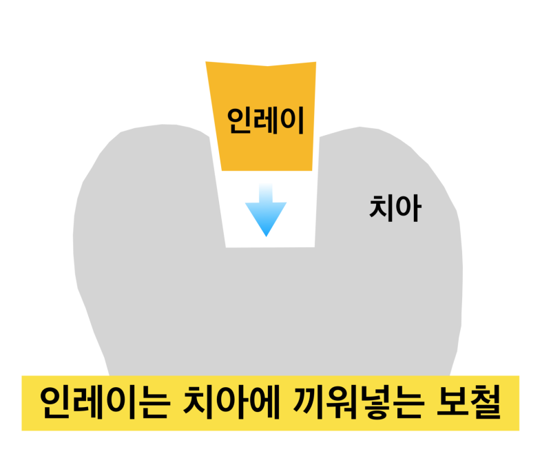 인레이 탈락, 금인레이 떨어지는 이유_캬라멜 먹다가 보철 빠지는경우_금니떨어짐