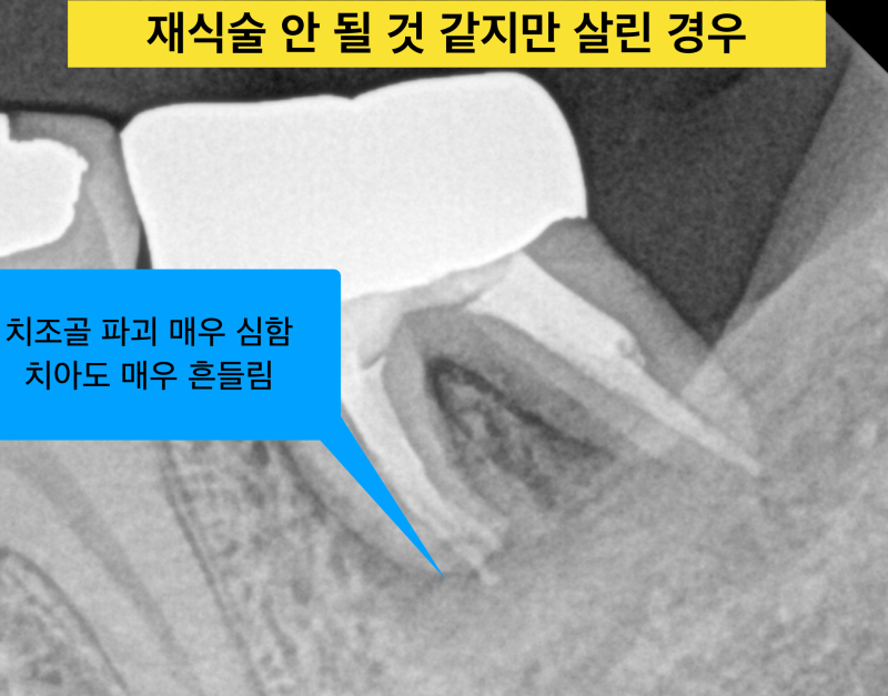 치아재식술 가능한 경우와 불가능한 경우, 나는 의도적재식술 치료가 가능할까? 사진 3