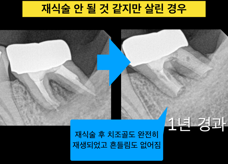치아재식술 가능한 경우와 불가능한 경우, 나는 의도적재식술 치료가 가능할까? 사진 4