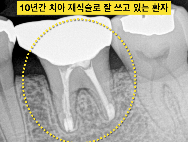 치아재식술 가능한 경우와 불가능한 경우, 나는 의도적재식술 치료가 가능할까? 사진 2