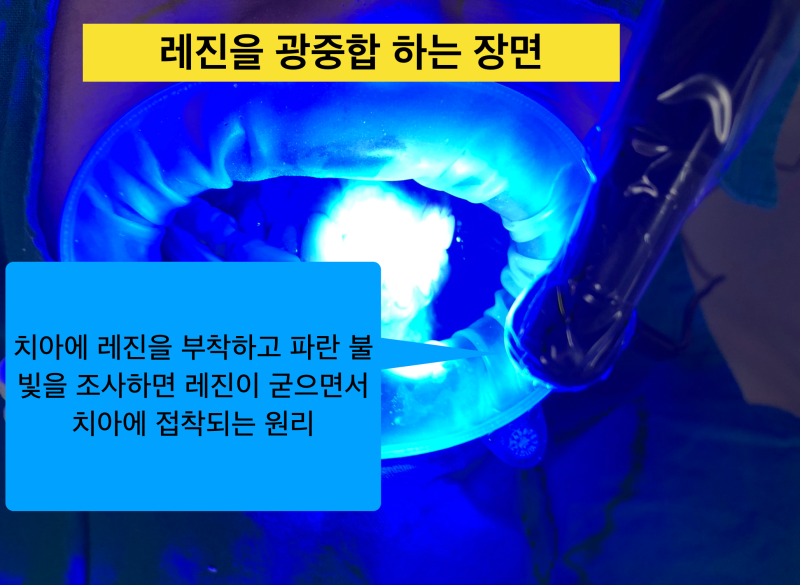 레진치료 후 통증_치과레진 치료 실패 원인_광중합레진 특징 사진 2