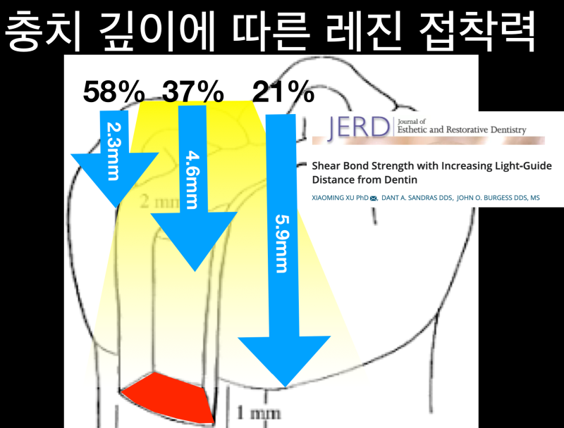 레진치료 후 통증_치과레진 치료 실패 원인_광중합레진 특징 사진 3