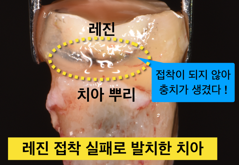 레진치료 후 통증_치과레진 치료 실패 원인_광중합레진 특징 사진 4