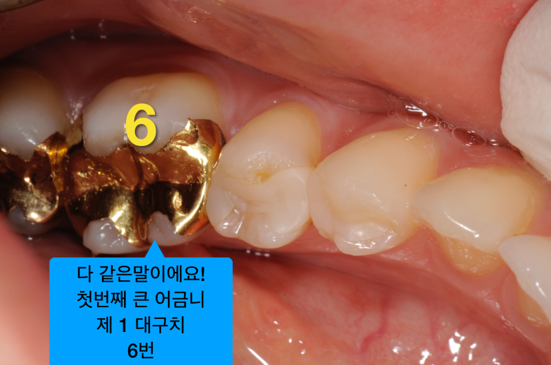 치과의료사고 예방, 치아번호 이것만 기억하자 (성인편)