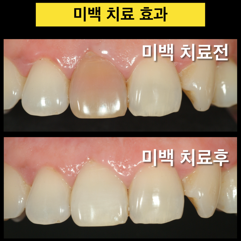 치아 변색 원인과 절대 치아를 깍으면 안 되는 이유 (치아미백치료, 실활치미백) 사진 5