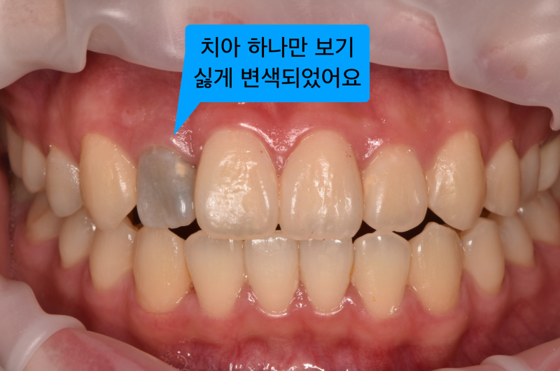 치아 변색 원인과 절대 치아를 깍으면 안 되는 이유 (치아미백치료, 실활치미백)