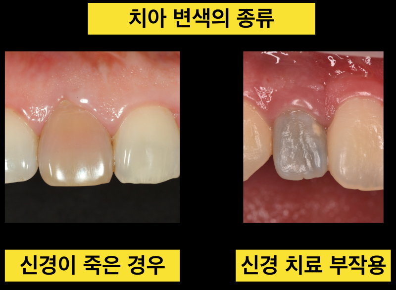 치아 변색 원인과 절대 치아를 깍으면 안 되는 이유 (치아미백치료, 실활치미백) 사진 4
