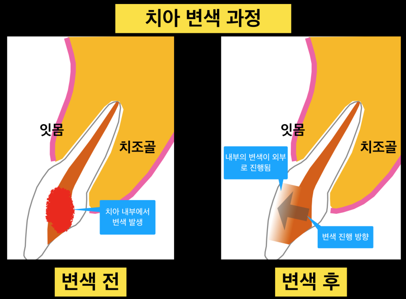 치아 변색 원인과 절대 치아를 깍으면 안 되는 이유 (치아미백치료, 실활치미백) 사진 3