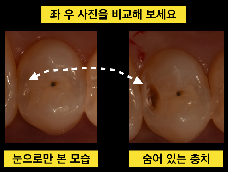 [알아야 지키는 소중한 내 치아] 구강검진 어디까지 믿을 수 있을까? 구강검진의 진실 사진 4