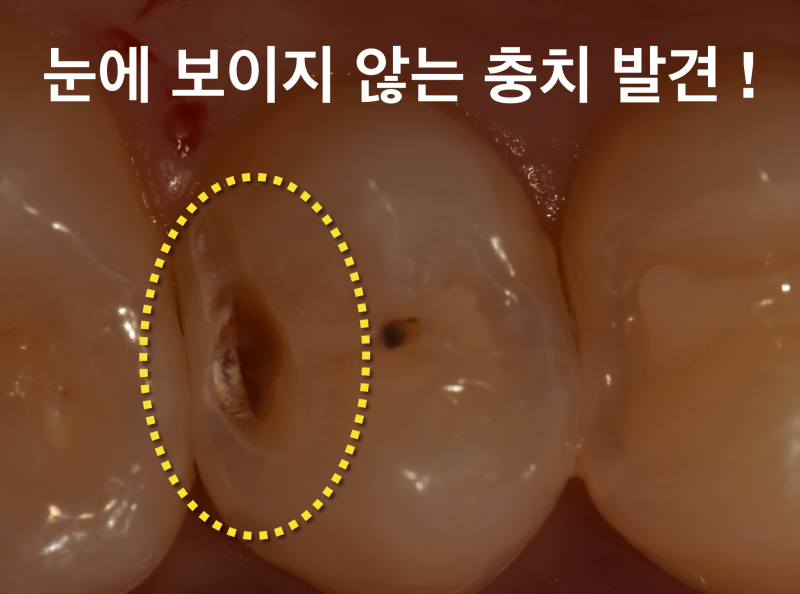 [알아야 지키는 소중한 내 치아] 구강검진 어디까지 믿을 수 있을까? 구강검진의 진실