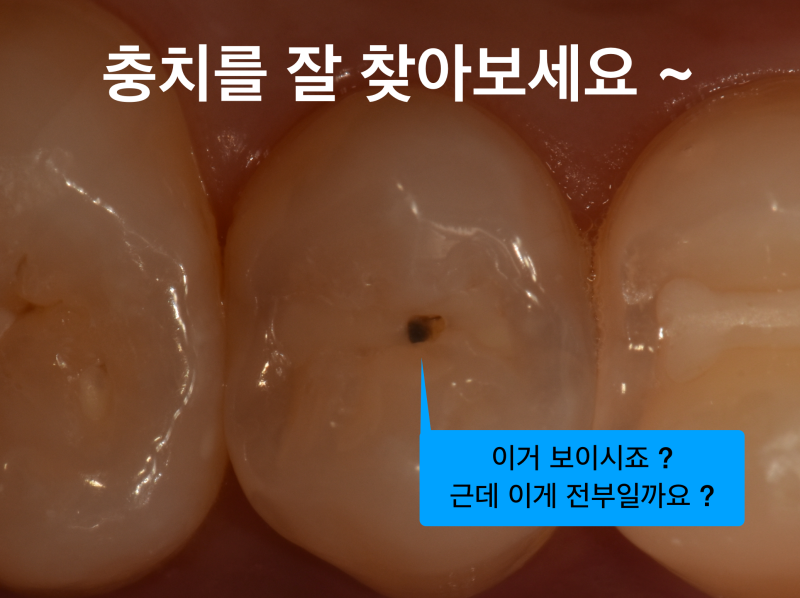 [알아야 지키는 소중한 내 치아] 구강검진 어디까지 믿을 수 있을까? 구강검진의 진실 사진 2
