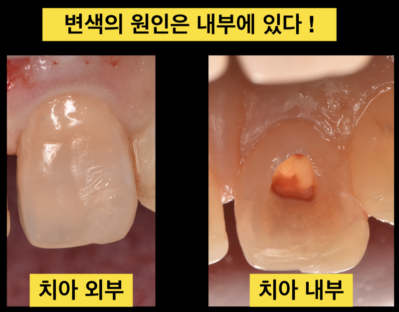 실활치 변색, 치아 미백 치아 내부가 중요한 이유 사진 3