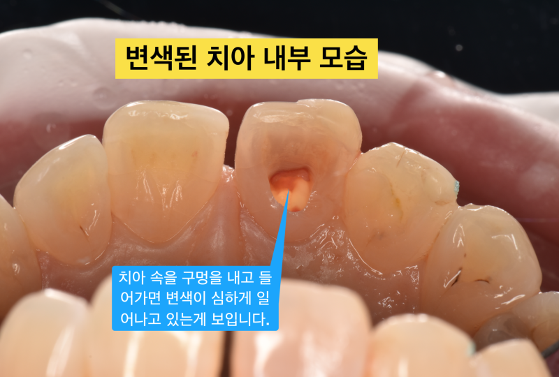 실활치 변색, 치아 미백 치아 내부가 중요한 이유