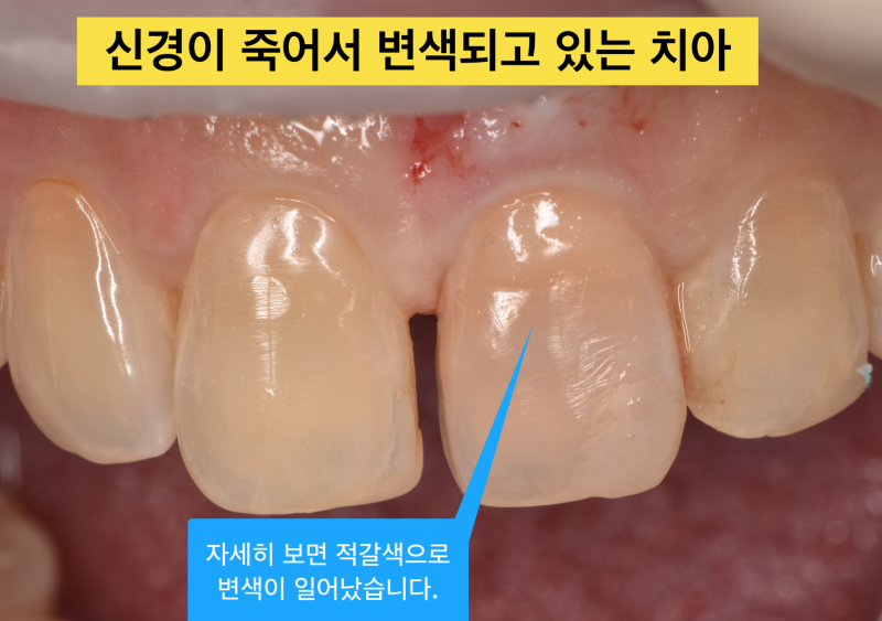 실활치 변색, 치아 미백 치아 내부가 중요한 이유