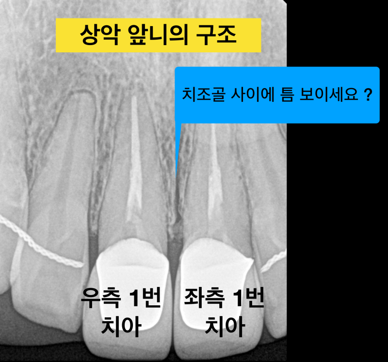 [안 아픈 치과 치료]앞니 안 아프게 치료 받는 법, 앞니 무통마취