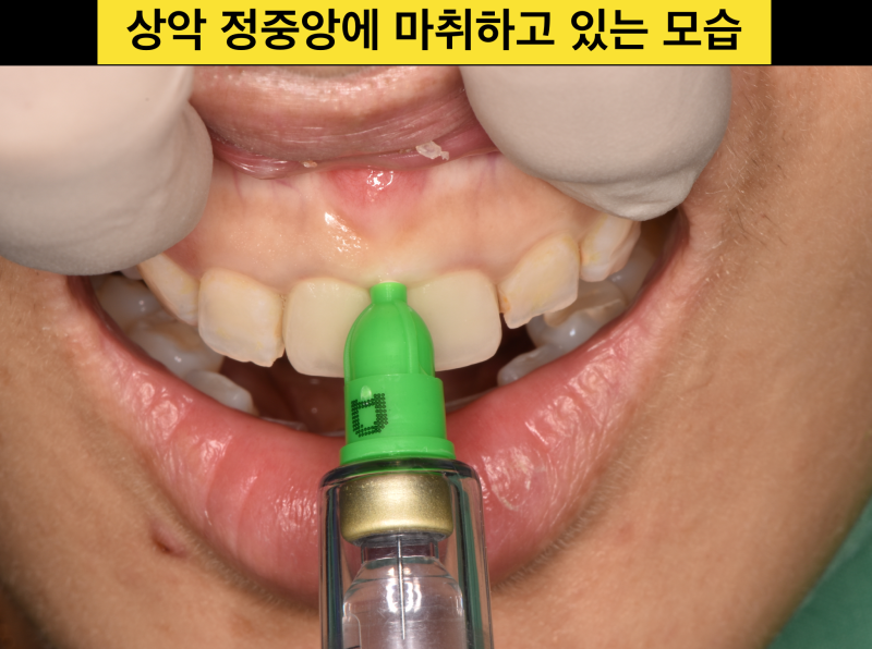 [안 아픈 치과 치료]앞니 안 아프게 치료 받는 법, 앞니 무통마취