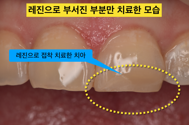 [앞니 레진 치료] 치아 일부가 깨졌을때 좋은 치료법, 크라운 대신 레진으로 자연 치아 보존하기 사진 2
