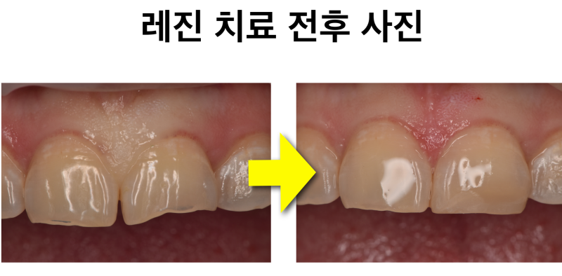 [앞니 레진 치료] 치아 일부가 깨졌을때 좋은 치료법, 크라운 대신 레진으로 자연 치아 보존하기