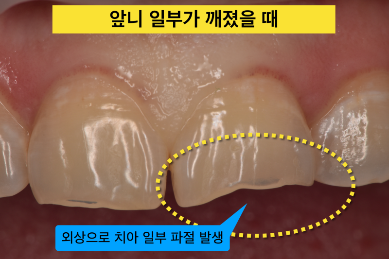 [앞니 레진 치료] 치아 일부가 깨졌을때 좋은 치료법, 크라운 대신 레진으로 자연 치아 보존하기