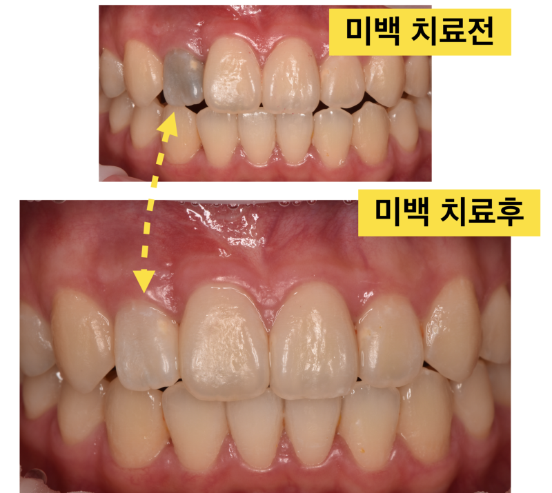 [치아 미백] 실활치 미백 결과, 치아를 깍지 않고 자연스럽게 색상 회복