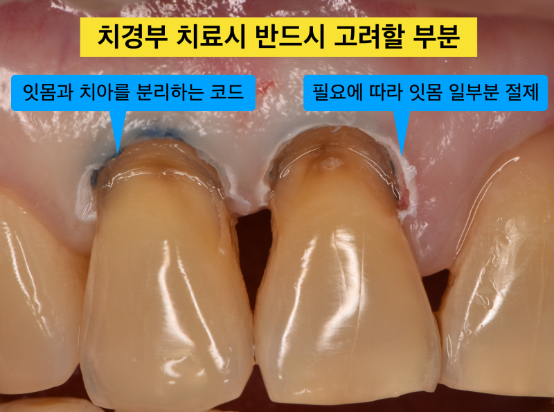 [치경부 레진 실전] 떨어지지 않는 치경부 레진 치료, 잇몸 통제가 제일 중요하다