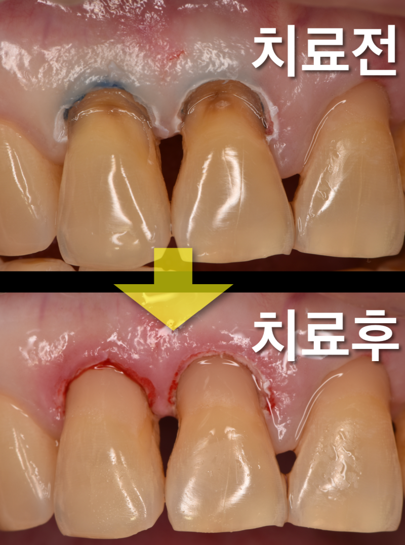 [치경부 레진 실전] 떨어지지 않는 치경부 레진 치료, 잇몸 통제가 제일 중요하다 사진 3