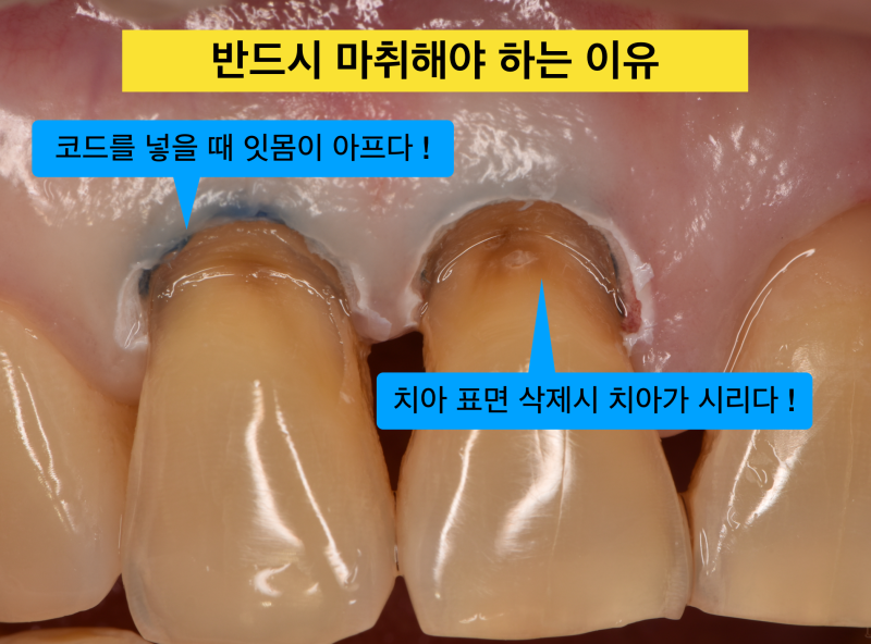 [치경부 레진 치료] 치경부 레진 마취는 선택이 아닌 필수 !