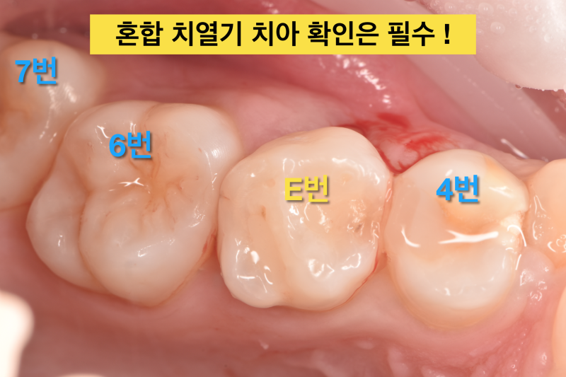 [어린이치과 치아번호] 유치와 영구치를 잘 구분하자
