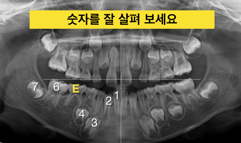 [어린이 치과] 영구치 확인은 필수 ! 파노라마 사진이 아이의 미래를 결정한다.