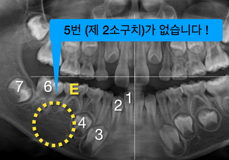[어린이 치과] 영구치 확인은 필수 ! 파노라마 사진이 아이의 미래를 결정한다. 사진 4