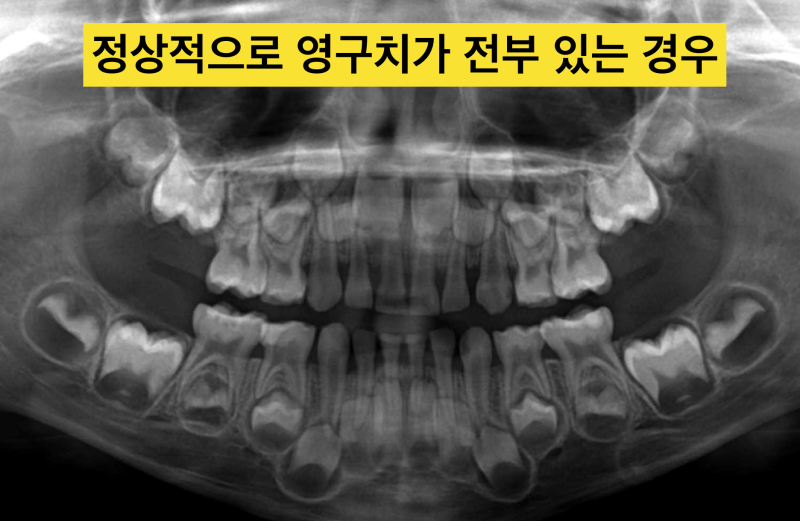 [어린이 치과] 영구치 확인은 필수 ! 파노라마 사진이 아이의 미래를 결정한다. 사진 2