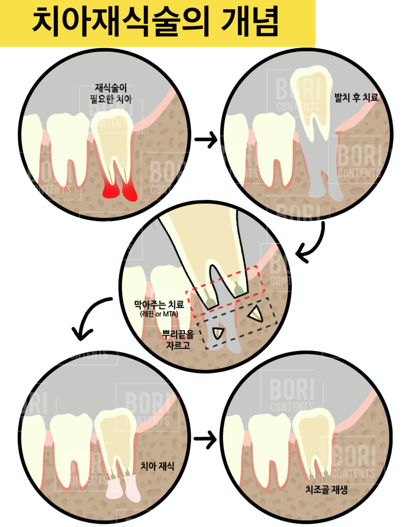[치아 살리는 재식술]치아 발치의 중요성과 주의점