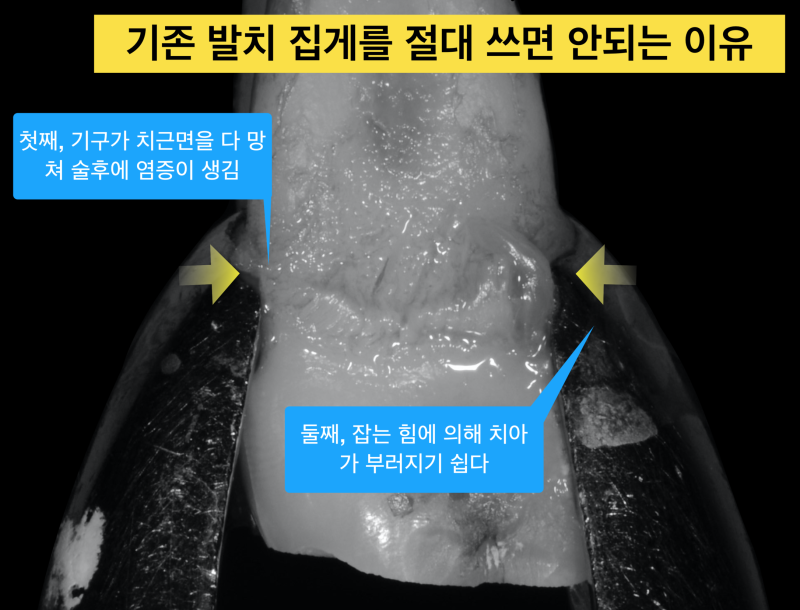[치아 살리는 재식술]치아 발치의 중요성과 주의점 사진 3