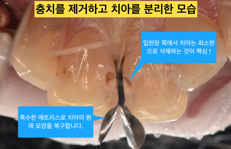 [앞니 레진]레진으로 치아 삭제는 최소화, 결과는 자연스럽게