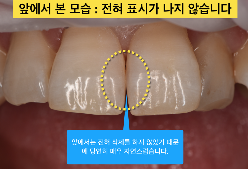 [앞니 레진]레진으로 치아 삭제는 최소화, 결과는 자연스럽게 사진 5