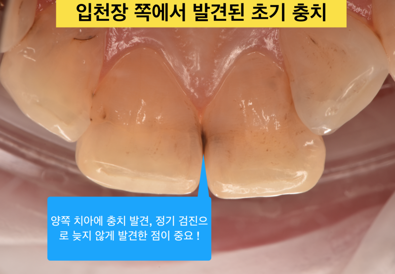 [앞니 레진]레진으로 치아 삭제는 최소화, 결과는 자연스럽게